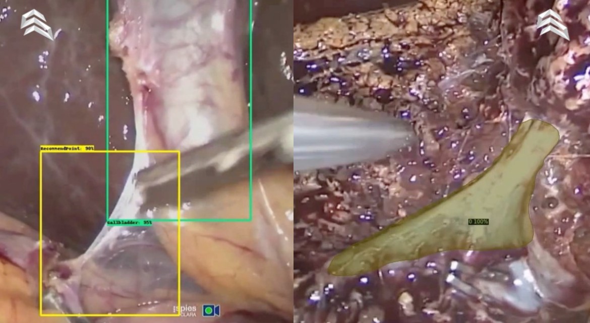 Cholecystectomy